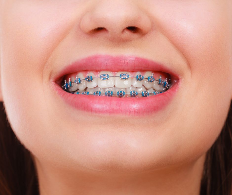 braces