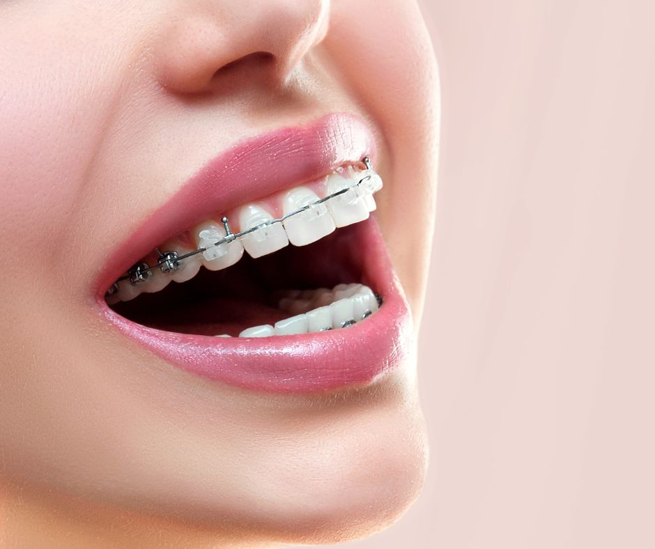 ceramic braces